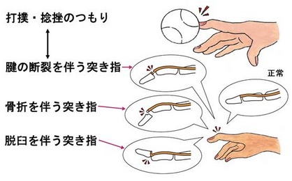 突き指の種類