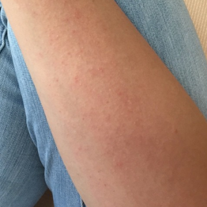 日光蕁麻疹,原因