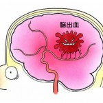 脳内出血